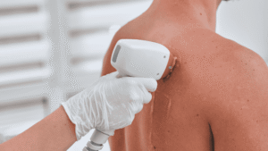 Why Men Are Turning To Laser Hair Removal