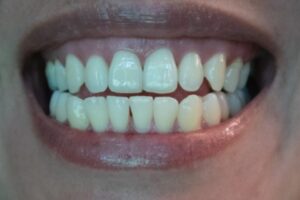 The Truth About Teeth and Aging: What You Need to Know